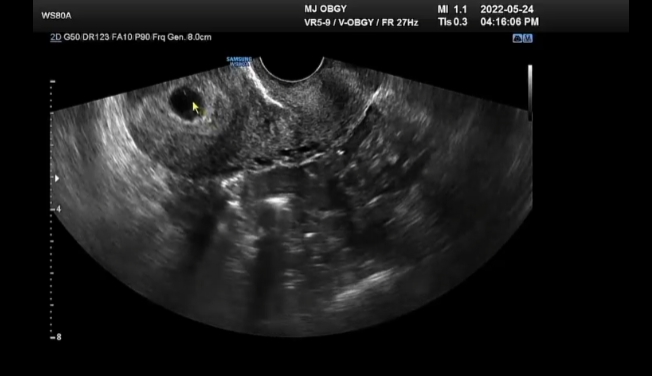 유혜디 블로그에 공개한 태아 초음파 사진