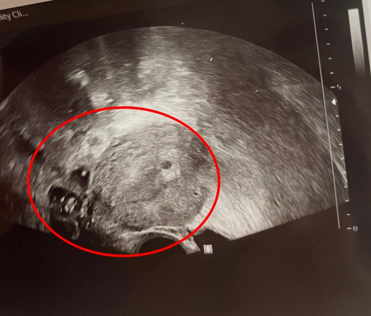 유혜디 블로그 임신 초음파 인증 사진